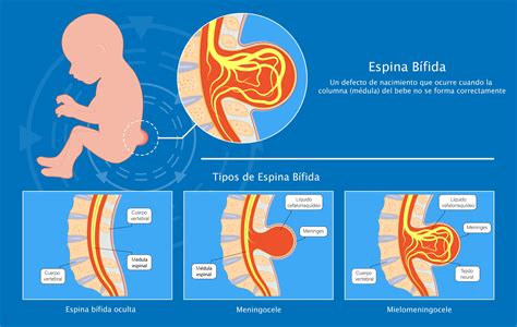 cuantos tipos de espina bifida hay